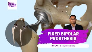 Fixed Bipolar Prosthesis  Implants amp Instruments [upl. by Kisor]