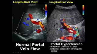 Liver Ultrasound Normal Vs Abnormal Image Appearances Comparison  Liver Pathologies USG [upl. by Lole528]