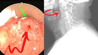 Epiglottitis Emergency Symptoms Causes Treatment [upl. by Solahcin]