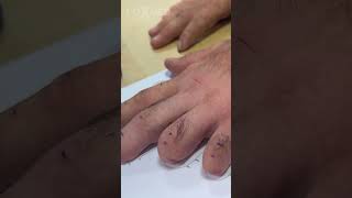 Silicone finger prostheses [upl. by Cummins]