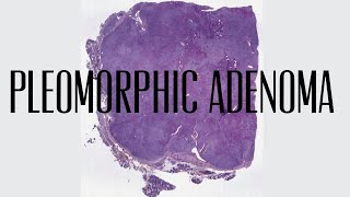 8 Pleomorphic adenoma [upl. by Atived]