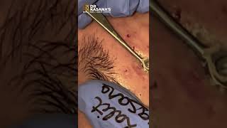 BLACKHEADS REMOVAL OF 50 YEARS OLD BLACKHEADS by DRLALIT KASANA [upl. by Zehe470]