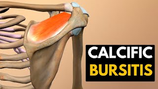 Calcific Bursitis Causes Signs and Symptoms Diagnosis and Treatment [upl. by Ideih151]