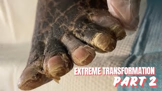 EXTREME FOOT TRANSFORMATION FINAL RESULT  PART 2 [upl. by Ahsinawt]