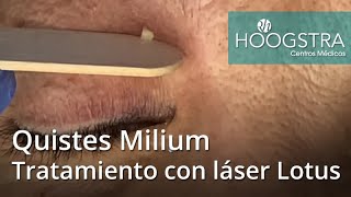 Quistes Milium  Tratamiento con láser Lotus 20219 [upl. by Anneyehc]