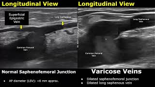 Saphenous Vein Doppler Ultrasound Normal Vs Abnormal  Varicose Veins  Lower Limb Vascular USG [upl. by Rehpotsirhcnhoj715]