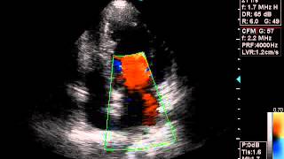 myxomatous degeneration of the mitral valve resulting in regurgitation [upl. by Adnole]