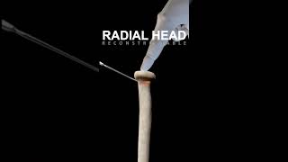 Radial head fracture fixed by screws [upl. by Gnus]