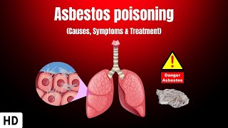 Asbestos Poisoning Causes Symptoms and Treatment [upl. by Lounge]