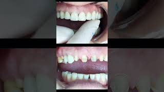 Anterior teeth Restoration  Zirconium Crown shorts dentist [upl. by Gromme]