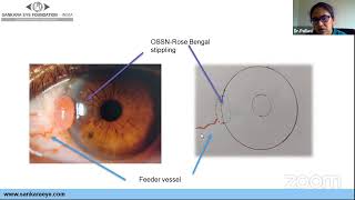 Corneal Drawing Colour Codes amp Stains Learn From Masters LetsGetonwithExams [upl. by Naivaf456]