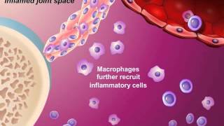 The Pathological Processes Leading to Persistence and Destructiveness of Synovitis [upl. by Paige]