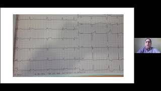 Pr Z LAKHAL  AOD et angioplastie coronaire [upl. by Enisaj]