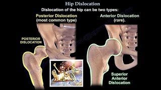 Dislocation of the hip  Everything You Need To Know  Dr Nabil Ebraheim [upl. by Yeclek]