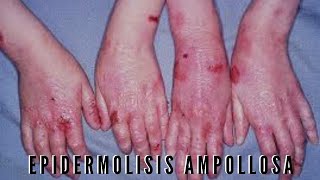 Epidermolisis ampollosa [upl. by Ebert]