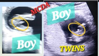 2 Baby Boys 🩵🩵  1 Posterior Placenta  14 Weeks Pregnancy Twins With Genderreveal  Baby Movements [upl. by Noryak632]