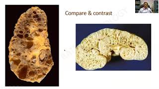 Cystic diseases of Kidney Urothelial Carcinoma  Bladder  RATS in Pathology  DrGShivashekar [upl. by Durno]