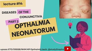 Opthalmiac Neonatorum Diseases of the conjuctiva part 2 UPSSSC ETO DSSSB Retractionist 2023📚✍️👀 [upl. by Ereveniug]