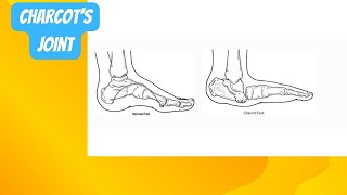 Charcot’s Joint  Charcot’s arthropathy [upl. by Weatherby]