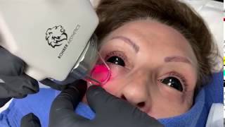 Tratamiento laser para bolsas en los ojos [upl. by Issej]