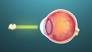 Presbyopia ophthalmology  Animation [upl. by Cornwall]