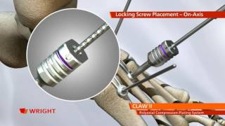 CLAW™ II Polyaxial Compression Plating Animation [upl. by Adlih]