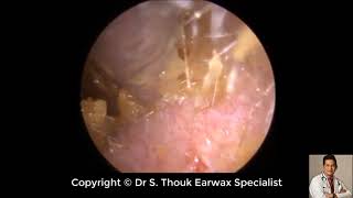 Top Biggest Ear Wax Removal 86  Ear wax Extraction  Dr S Thouk Earwax Specialist [upl. by Bergstrom237]