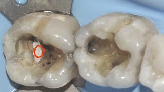 Use the Latest Materials to Protect the Pulp and Enhance Your Restorations [upl. by Marga430]