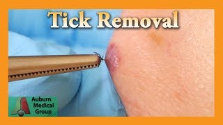 Dead Tick Removal  Auburn Medical Group [upl. by Ibocaj595]