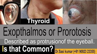 Exopthalmos or Prorotosis  Described as protrusion of the eyeball [upl. by Fries]