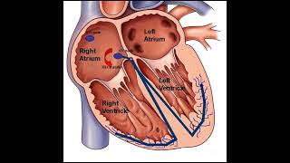 Atrioventricular Nodal Reentrant Tachycardia AVNRT Disease healthcare health disorder [upl. by Devin185]