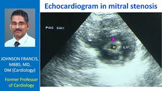 Echocardiogram in mitral stenosis [upl. by Tj]