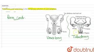 Tubectomy and vasectomy is the temporary solution of contraception [upl. by Orran13]