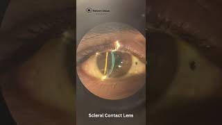 Contact Lens Fitting in Keratoconus  RGP Lenses  Rose K2 Lenses  Scleral Lenses  Hyderabad [upl. by Schwitzer]