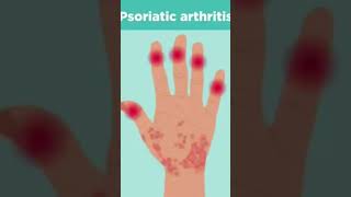 Psoriatic arthritis rheumatology psoriasis ytshort ytytshorts [upl. by Iny79]