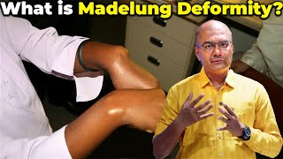 Madelung Deformity Explained Causes Symptoms and Treatment  Understanding Wrist Deformities [upl. by Booker]