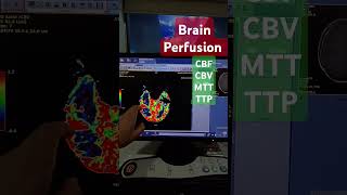 Mri Brain Perfusion contrast brain perfusion CBV CVF MTT TTP mri perfusion [upl. by Horne]