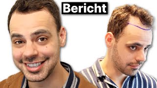 Damirs Bruder lässt sich die Geheimratsecken auffüllen  Haartransplantation Erfahrung [upl. by Gertrudis]