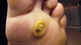 Wart Removal How to Get Rid of Planters Wart on Foot at Home Fast amp Naturally [upl. by Nortad676]