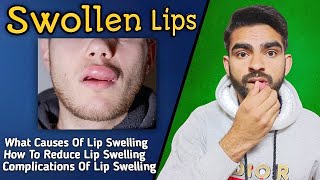 Swollen Lips in urduhindi  How to get rid of swollen lips  Swollen lips treatment [upl. by Alyehs]