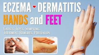 Eczema on Hands and Feet Causes Symptoms Types Treatment Remedies Prevention  Dermatitis treat [upl. by Nhojleahcim235]