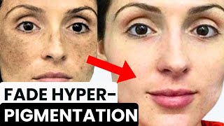 HOW TO GET RID OF HYPERPIGMENTATION MELASMA DARK SPOTS SUN SPOTS POSTINFLAMMATORY ERYTHEM [upl. by Orelia]