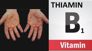 Vitamin B1 Thiamine deficiency symptoms food sources and benefits of the B1 vitamin [upl. by Yralam698]