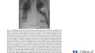 Basic Management of Perioperative Pacemakers  Dr Murphy [upl. by Jandel]