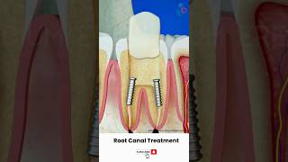 Root Canal Treatment Procedure ↪ 3D Medical Animation Shorts RootCanal Tooth [upl. by Naret]