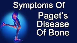 Symptoms Of Pagets Disease Of Bone [upl. by Campos11]