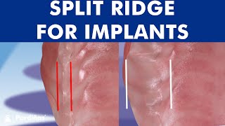 ALVEOLAR RIDGE EXPANSION  Dental implant placement with bone ridge splitting © [upl. by Enimasaj920]