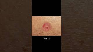 Basal Cell Carcinoma Skin Cancer Development Time Lapse Normal to Cancer Over 25 Years [upl. by Arikihs208]