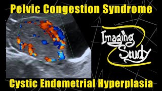 Pelvic Congestion Syndrome amp Endometrial Cystic Hyperplasia  Ultrasound  Doppler  Case 90 [upl. by Etnahc]