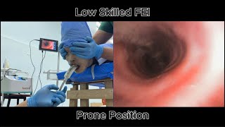 combination of flexible and supraglottic airway device on a patient in prone position [upl. by Moule]